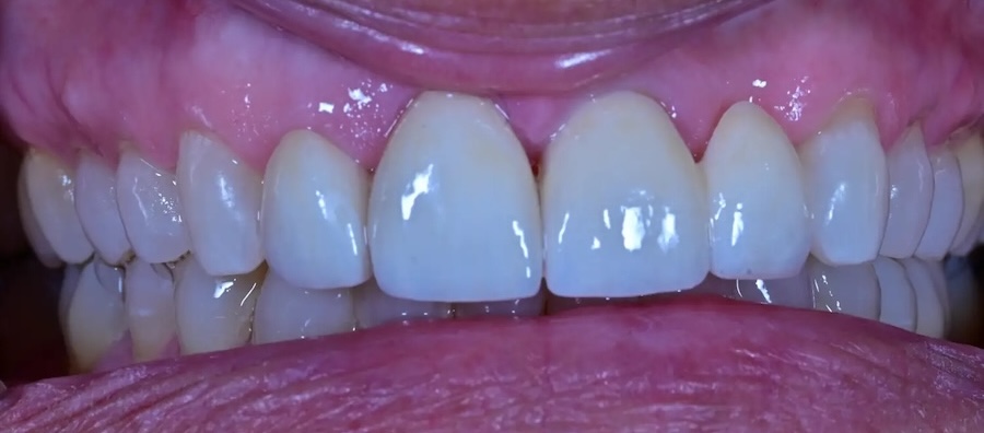 Tooth Replacement & Crowns After