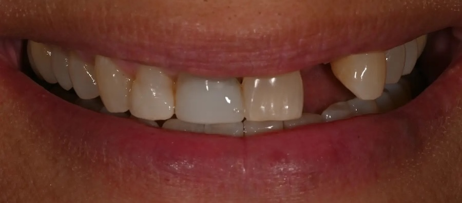 Tooth Replacement & Crowns Before