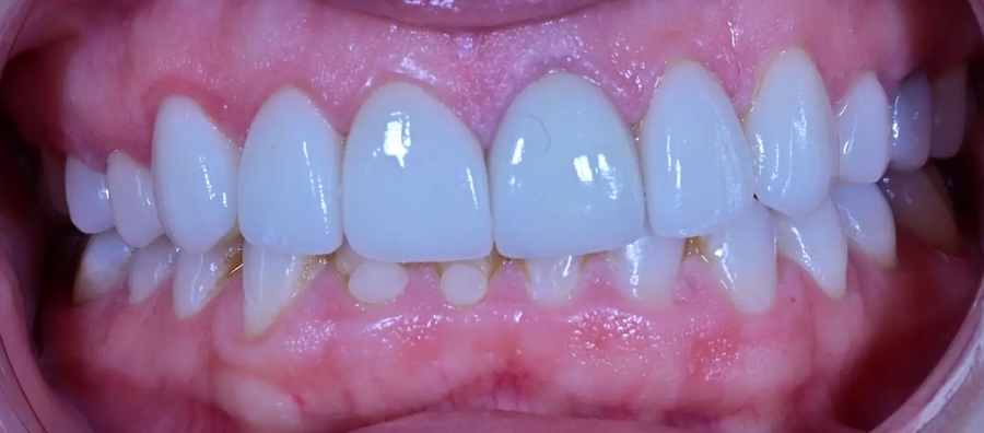Crowns & Veneers After