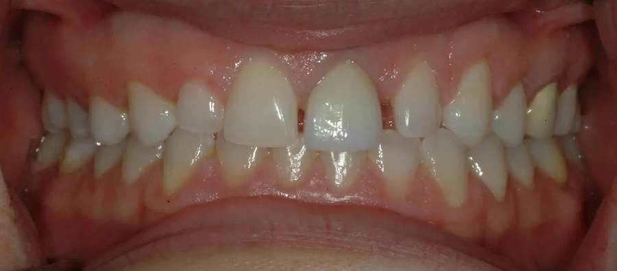 Crowns & Veneers Before