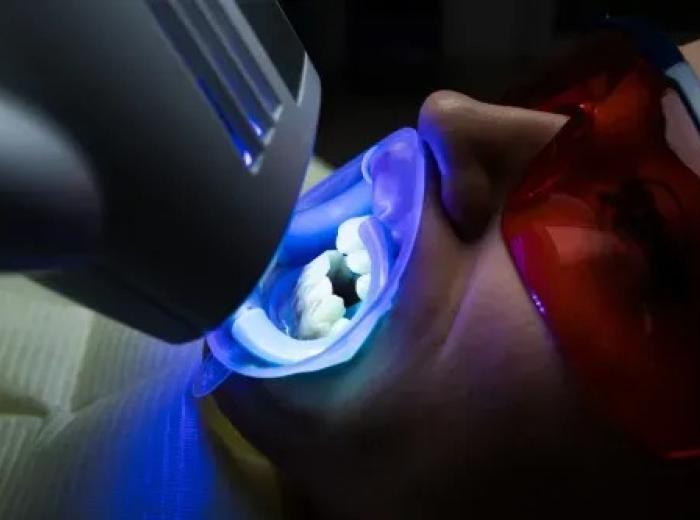 Enamel-Safe Radiance: Professional Whitening vs. Store-Bought Strips