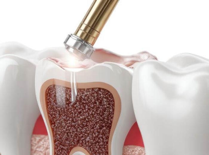 Are Dental Lasers Effective? What Patients Should Know