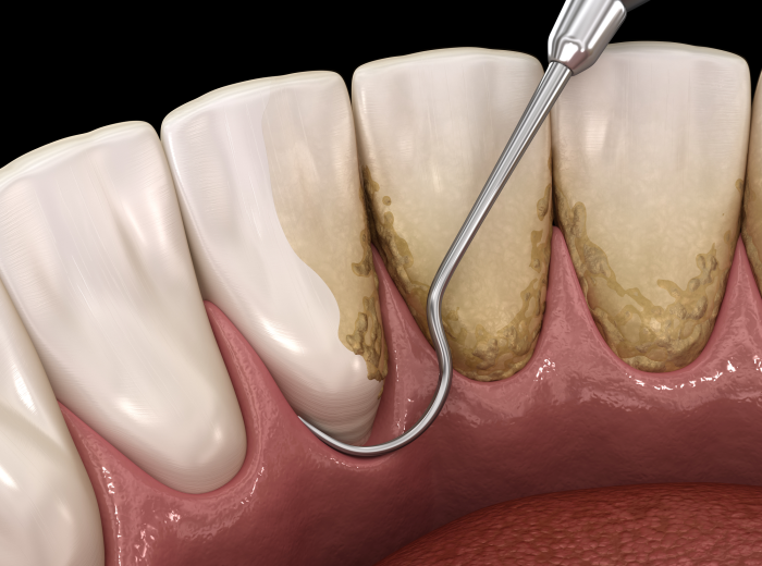 The Stages of Periodontitis: Understanding the Progression